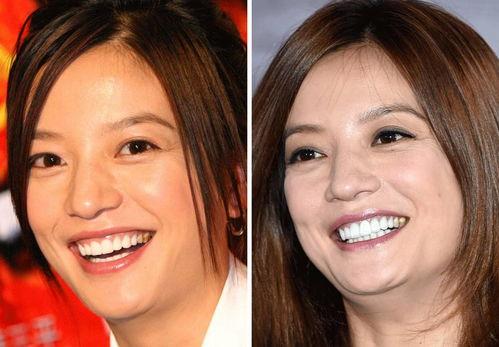 明星都是假牙吗